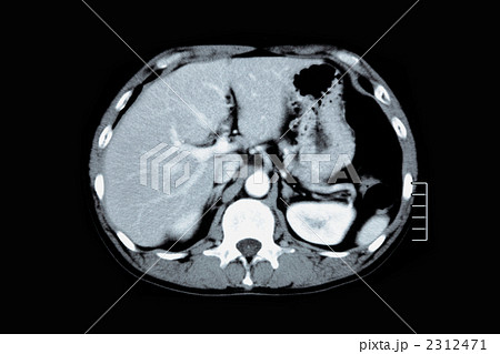 腹部造影ctの写真素材