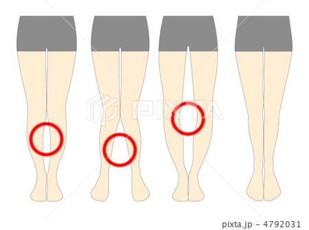 がに股 骨盤矯正のイラスト素材