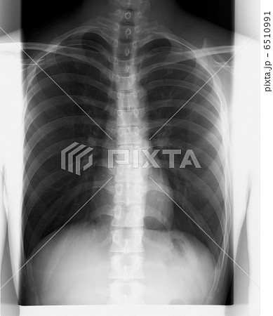 レントゲン 胸部 人体 肋骨の写真素材