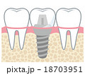 歯 インプラント 構造 名称のイラスト素材
