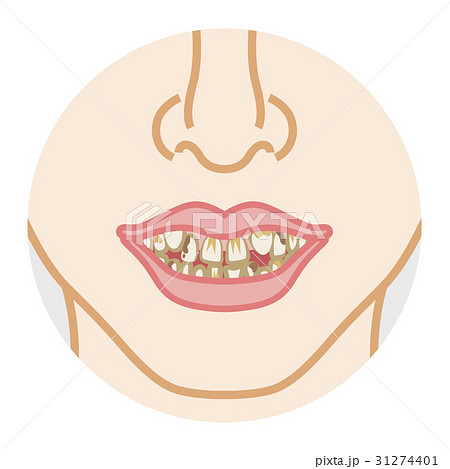 歯 歯並び 虫歯 汚いのイラスト素材 Pixta
