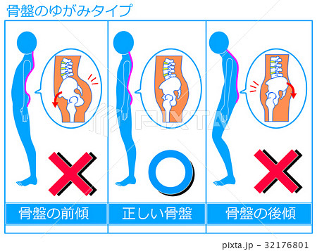 「反り腰 フリー素材」の画像検索結果