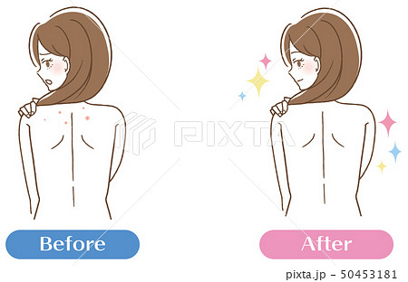 女性 背中 悩み ニキビのイラスト素材