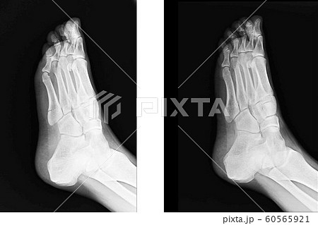 骨 骨折 足 レントゲンの写真素材