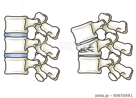 圧迫骨折のイラスト素材
