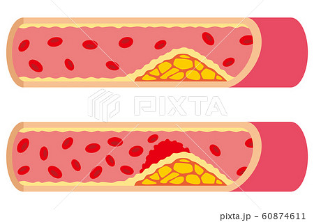 動脈硬化のイラスト素材