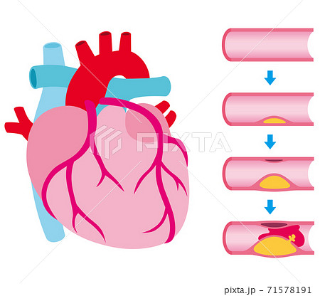 冠動脈のイラスト素材