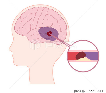 脳血管障害のイラスト素材