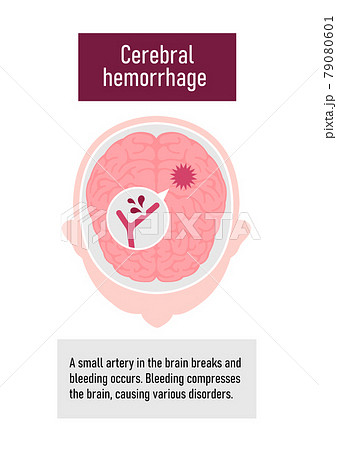 脳出血のイラスト素材