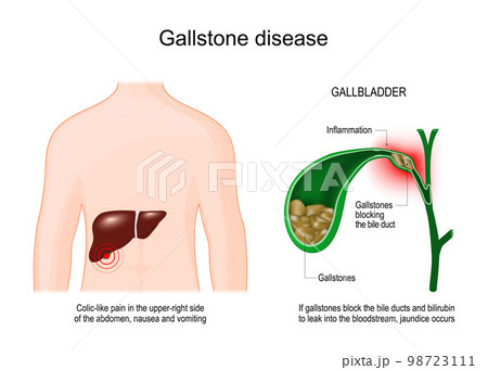 gallstones in women
