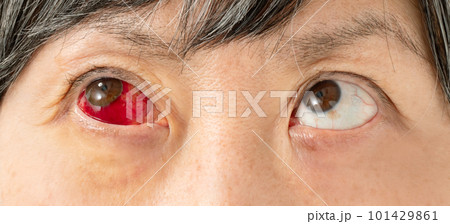 赤目 眼の写真素材 - PIXTA
